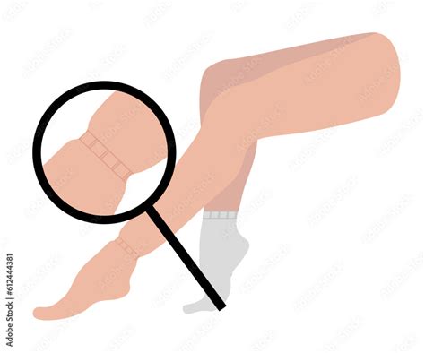 edema female legs sitting  swollen foot  ankle lymphedema