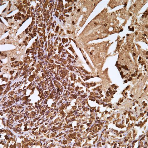 vimentin pathology resident wiki fandom