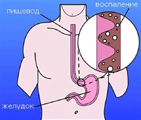 Эзофагит: симптомы и лечение. Диагностика и лечение