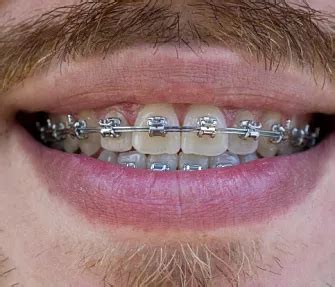 Что такое микровинт? Объясняют стоматологи Colibri Dental