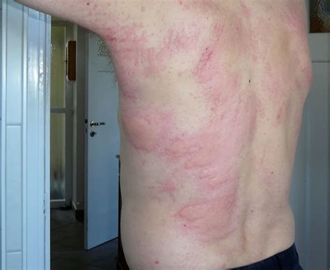 Urticaria Aquagenica Sintomas