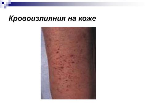 Сестринский процесс при геморрагических диатезах - презентация онлайн