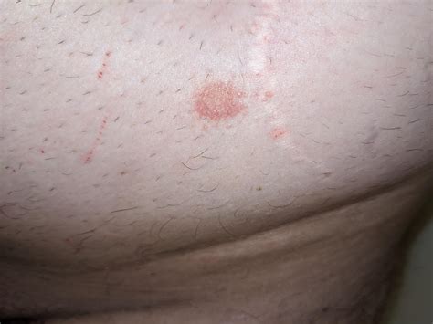 Lesiones Cutaneas