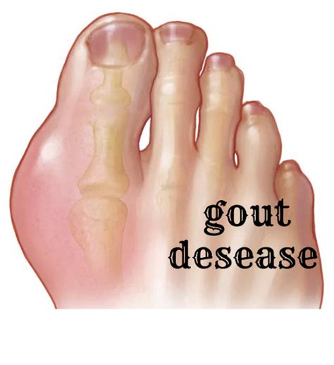 Understanding Gout: Symptoms, Causes, Prevention, and Treatment