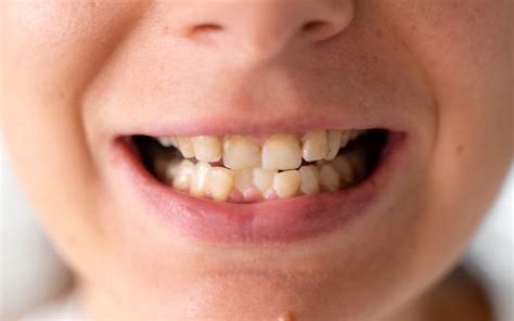 Malocclusion: Causes and Treatment Options in Perth