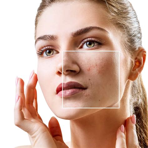 how to get rid of facial redness