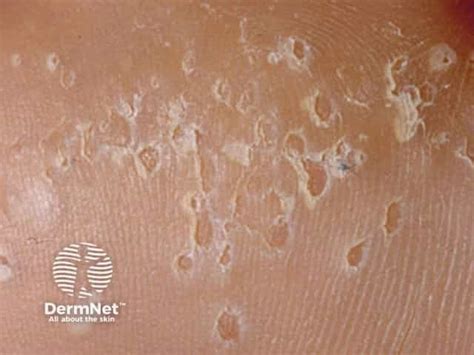 pitted keratolysis symptoms   treatment dermnet
