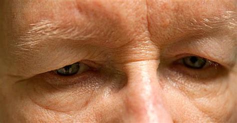 Living with Fibro: It's called "Dermatochalasis"