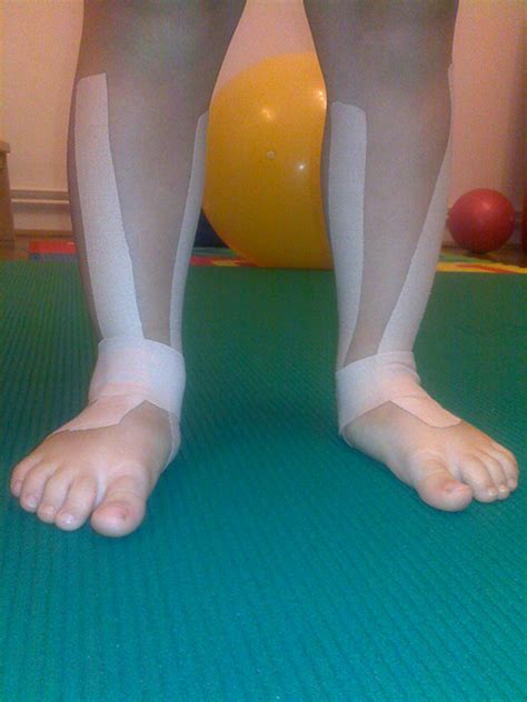 Kinesiotaping - Fizikalna terapija za djecu