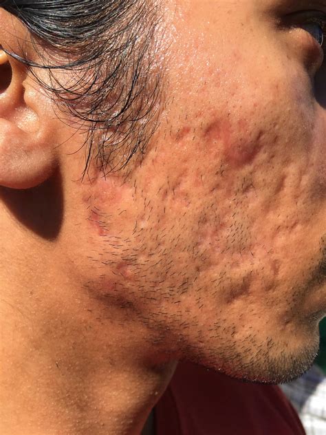 Acne, causes, types,, diagnosis, treatment & prognosis