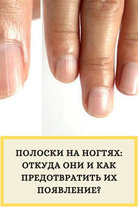 Продольные полосы на ногтях (54 фото)