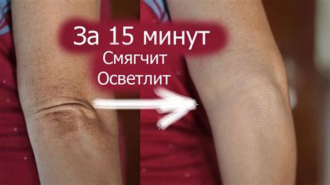 Сухая шершавая кожа на локтях. Темные грубые локти что делать. 15 мин ...