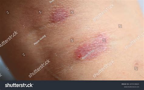 Psoriasis Skin Disease Causes Rash Itchy Stock Photo 2272136621 ...