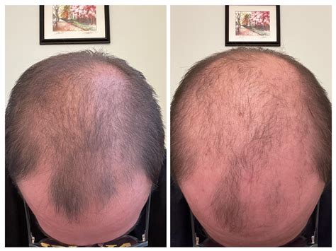 3 month update progress pictures : r/tressless