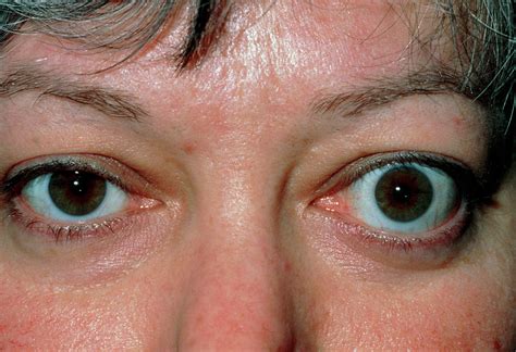 bulging eye exophthalmos due  thyrotoxicosis photograph  dr p