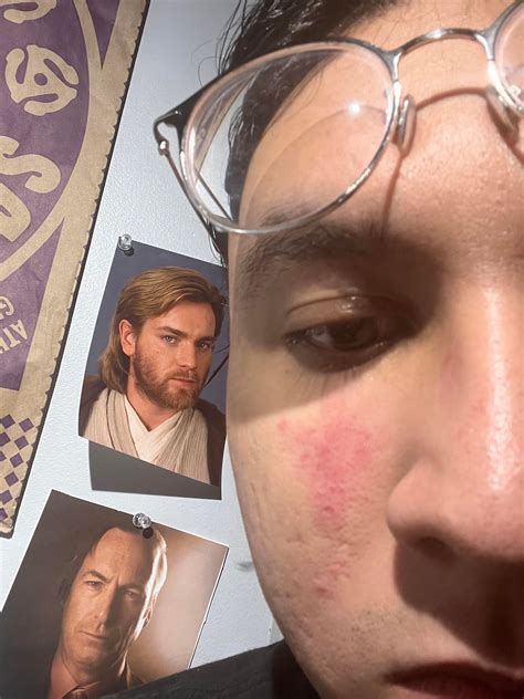 [Product Request] Dry, red and irritating patch has formed on my face