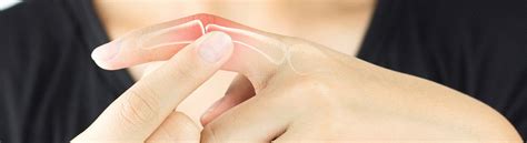 how to know if a finger is broken or sprained