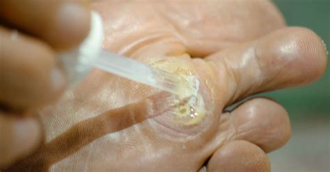 seed corn foot removal