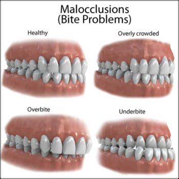 Here’s How To Tell Overbite Vs Normal Teeth Bite