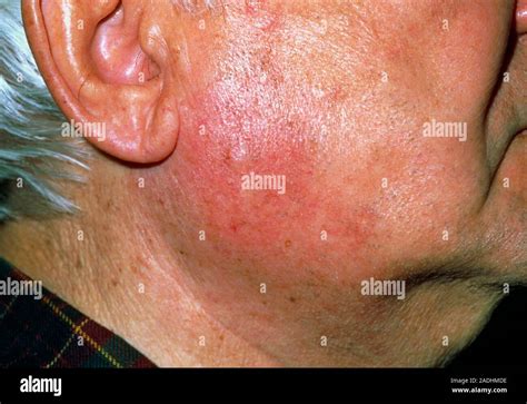Inflamed parotid gland in the cheek of a 78-year- old man. This patient ...