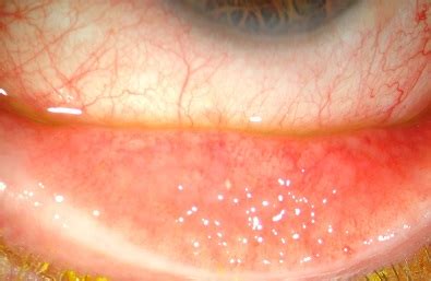 follicular conjunctivitis  follicular conjunctivitis