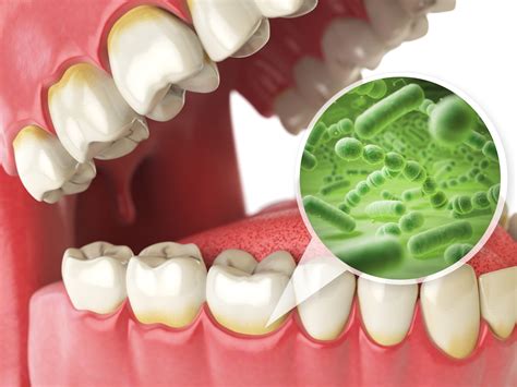 Tooth Infection: Home remedies - Torbram Dental