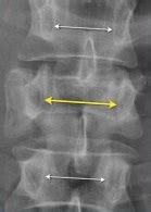 glossary  achondroplasia