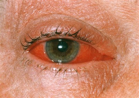 Viral conjunctivitis - Stock Image - M155/0439 - Science Photo Library