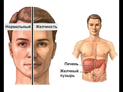 Личный опыт синдром Жильбера какого это? Можно ли жить и как с этим ...