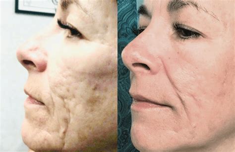 CO2 Laser | Bella Grey Medical Spa