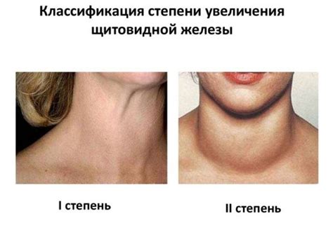 Бартолиновая железа где находится картинки