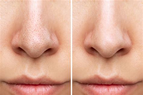 how to make the pores smaller 11