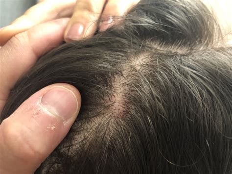 Raised bump on scalp. I’ve had this bump for about 10 years and have noticed it a few times, it ...