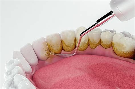 What Is Dental Plaque - Bacterial Plaque, Tartar, Gingivitis, Gum Disease