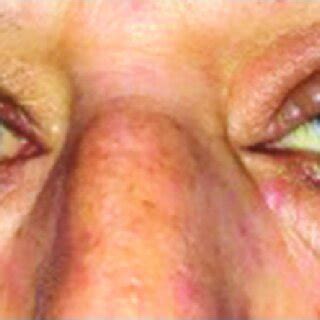 photograph showing  diffuse left periorbital edema