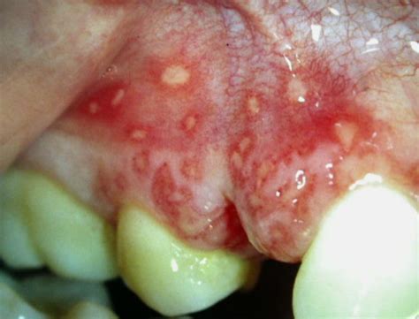 viral infections   mouth symptoms  pictures