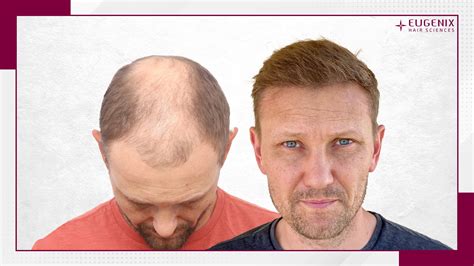 hair transplant    eugenix hair sciences