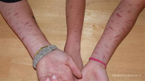 Crece la moda del 'cutting' entre adolescentes