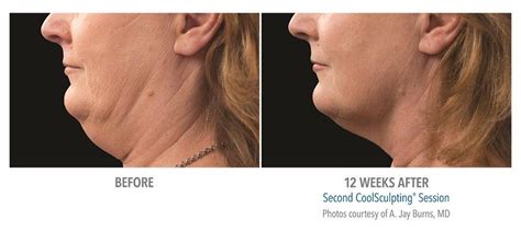 CoolMini Coolsculpting Neck Fat Treatment Northern Virginia | Tysons Corner