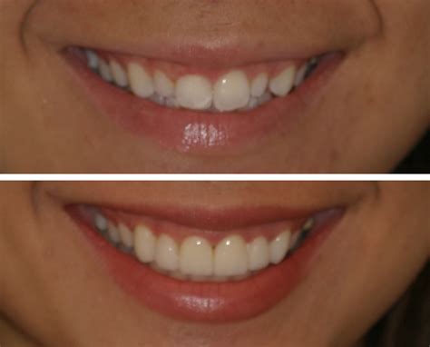Veneers Before And After Pictures | Before And After