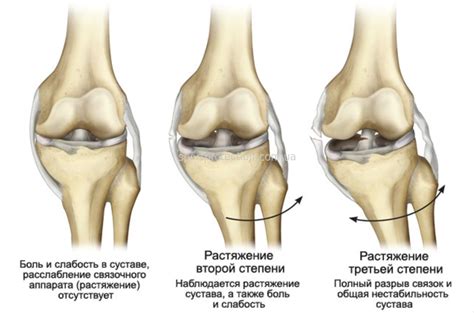 Повреждение коллатеральной связки коленного сустава лечение