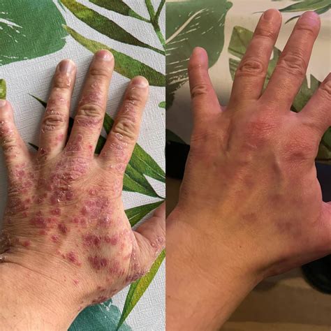 Marcel manages psoriatic arthritis on the carnivore diet