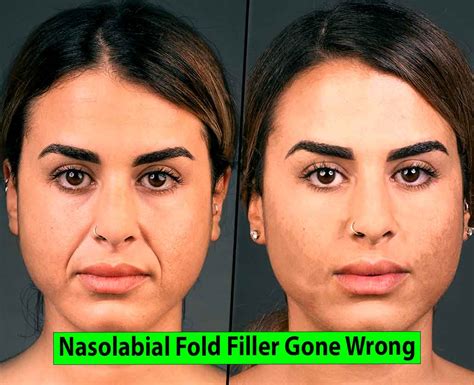 Nasolabial Fold Filler Gone Wrong - Healthy Anozo