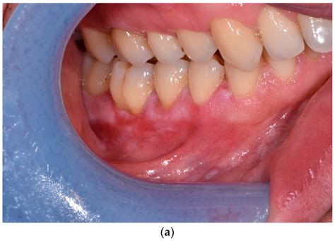 Treatment of Reticular Oral Lichen Planus with Photodynamic Therapy: A