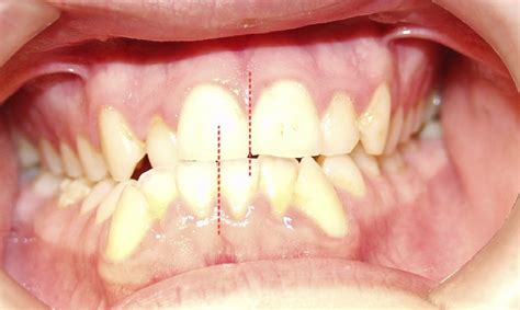 midline deviation wikilectures