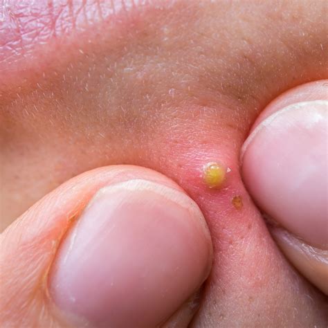 New Popping Huge Zit On The Face Ever Pimple Popping Pimple Patches