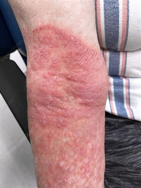 Ringworm - Stock Image - C059/6968 - Science Photo Library
