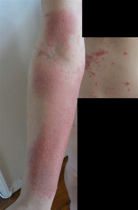 how to get rid poison ivy rash 3