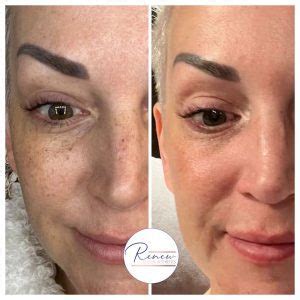 Sciton Forever Young BBL - Renew Medical Aesthetics