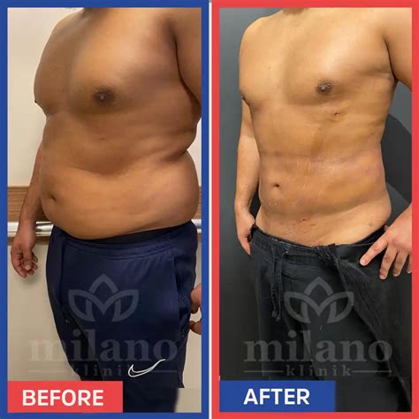 belly fat surgery